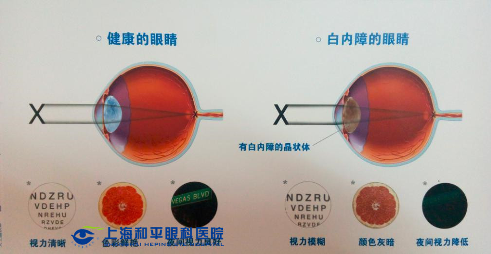 眼睛晶体植入还能拿出来吗_眼睛植入晶体多少钱_眼睛晶体植入