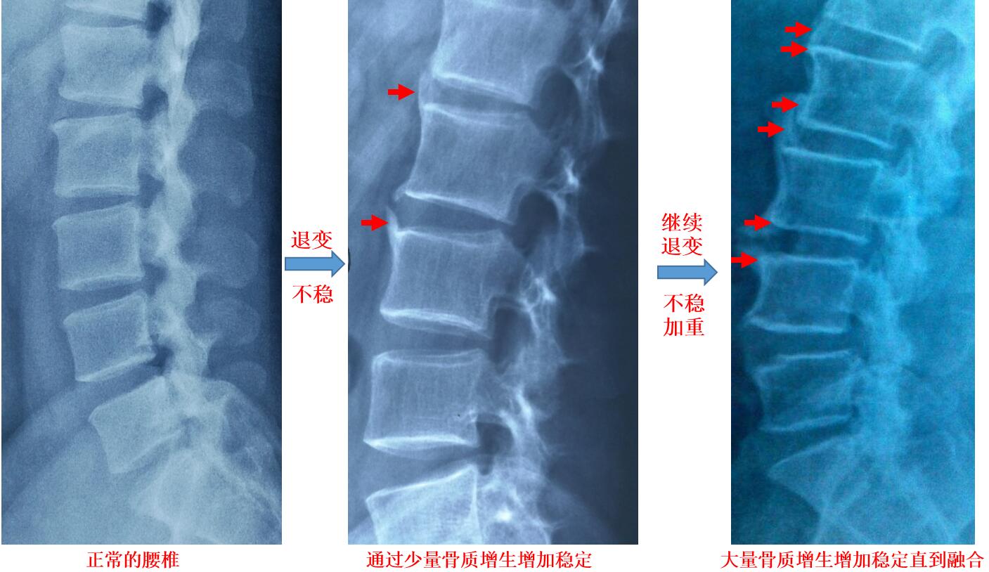 骨刺竟然是好东西?原来我们一直都错怪骨质增生了