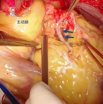 体外循环下肌桥松解术冠状动脉心肌桥的一种根治方案