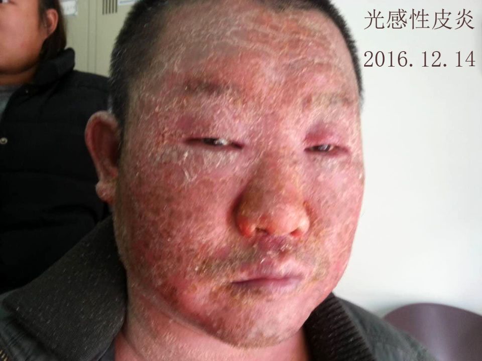 光感性皮炎两例 - 微医(挂号网)