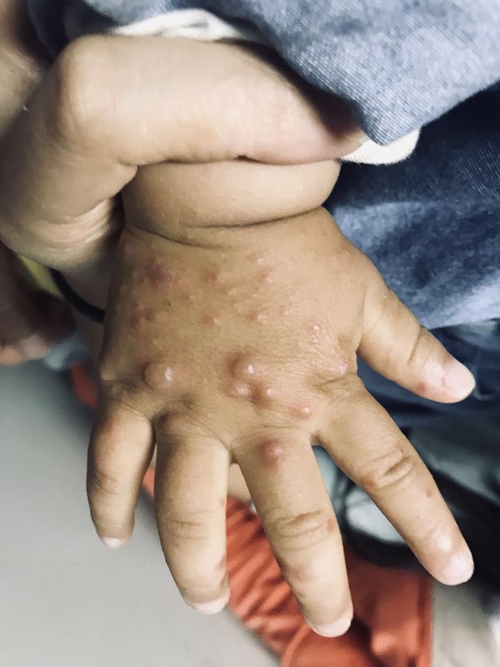正确认识手足口病