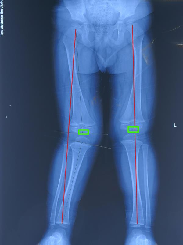 儿童矫形8字钢板半骺阻滞术治疗儿童膝外翻畸形