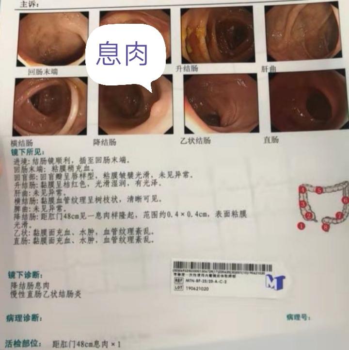 肠镜息肉报告图片