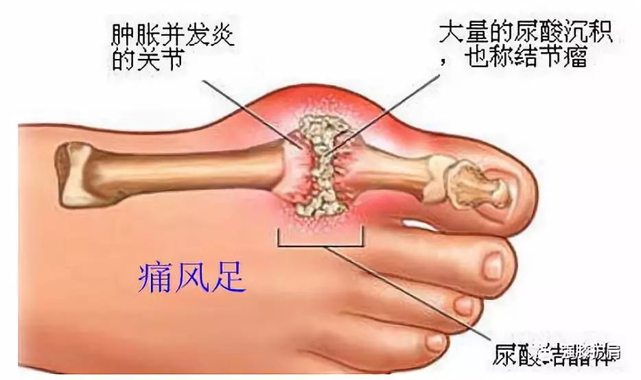 痛风性膝关节炎的微创关节镜治疗