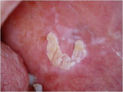 口腔粘膜病白斑图片图片