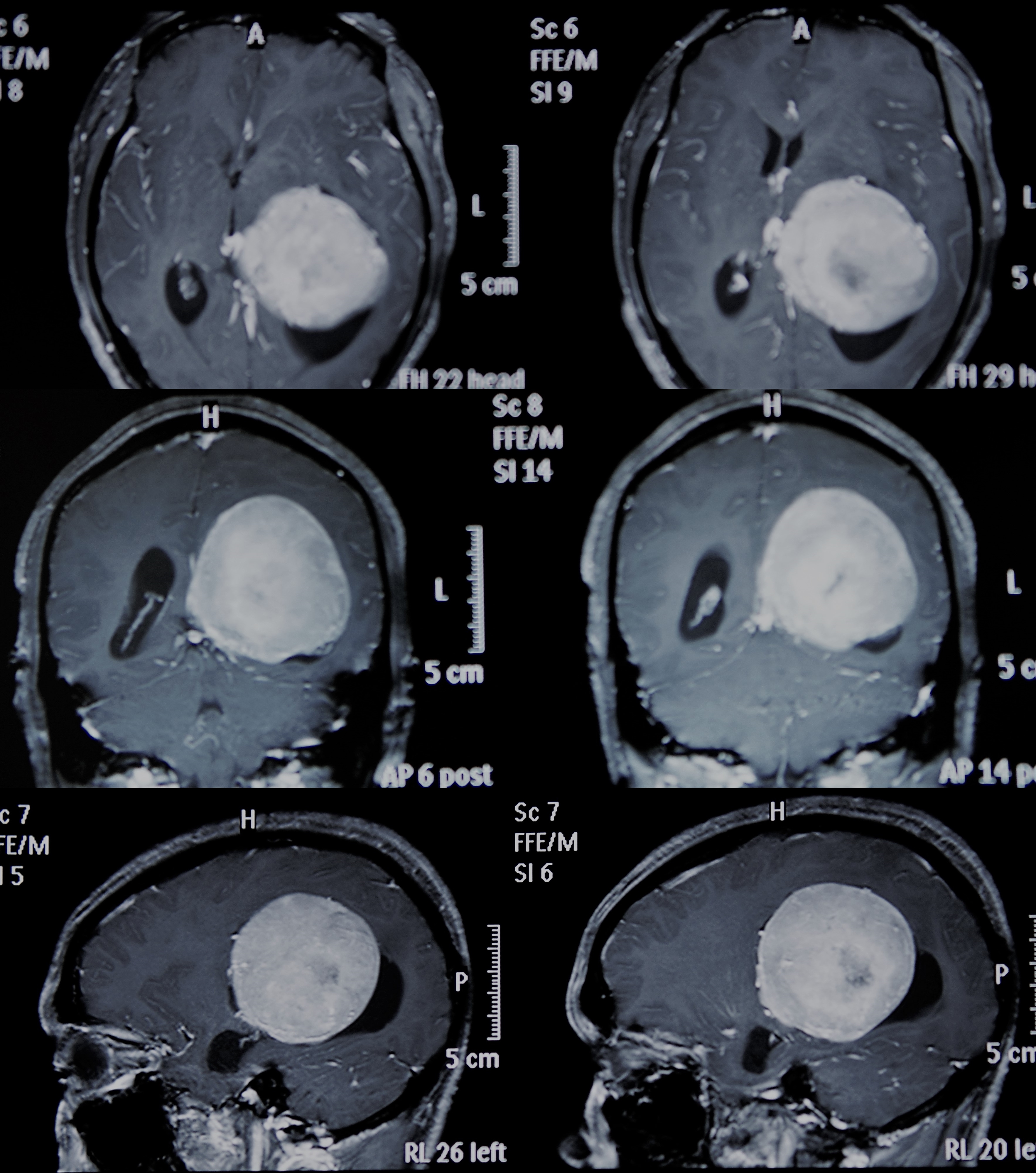 形形色色脑膜瘤 - 微医(挂号网)