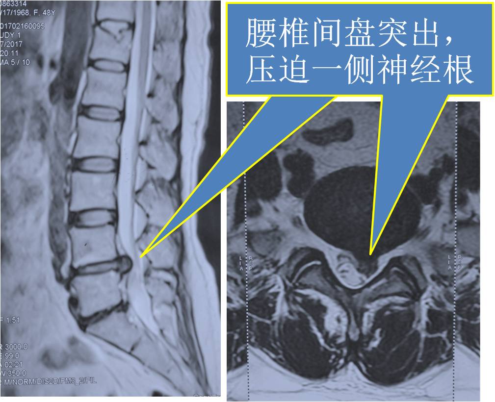 图5 腰椎间盘突出压迫硬膜囊和神经根三治疗1