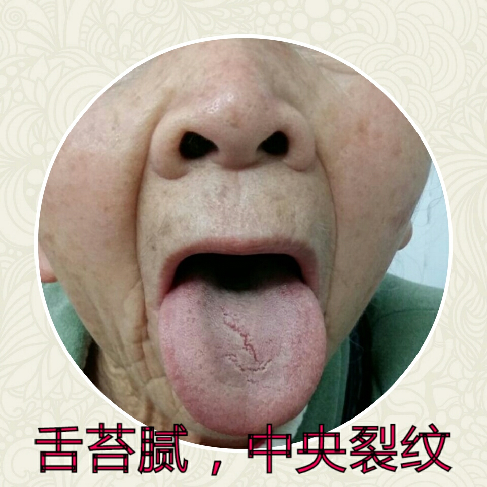 主诉舌灼热口干3年.