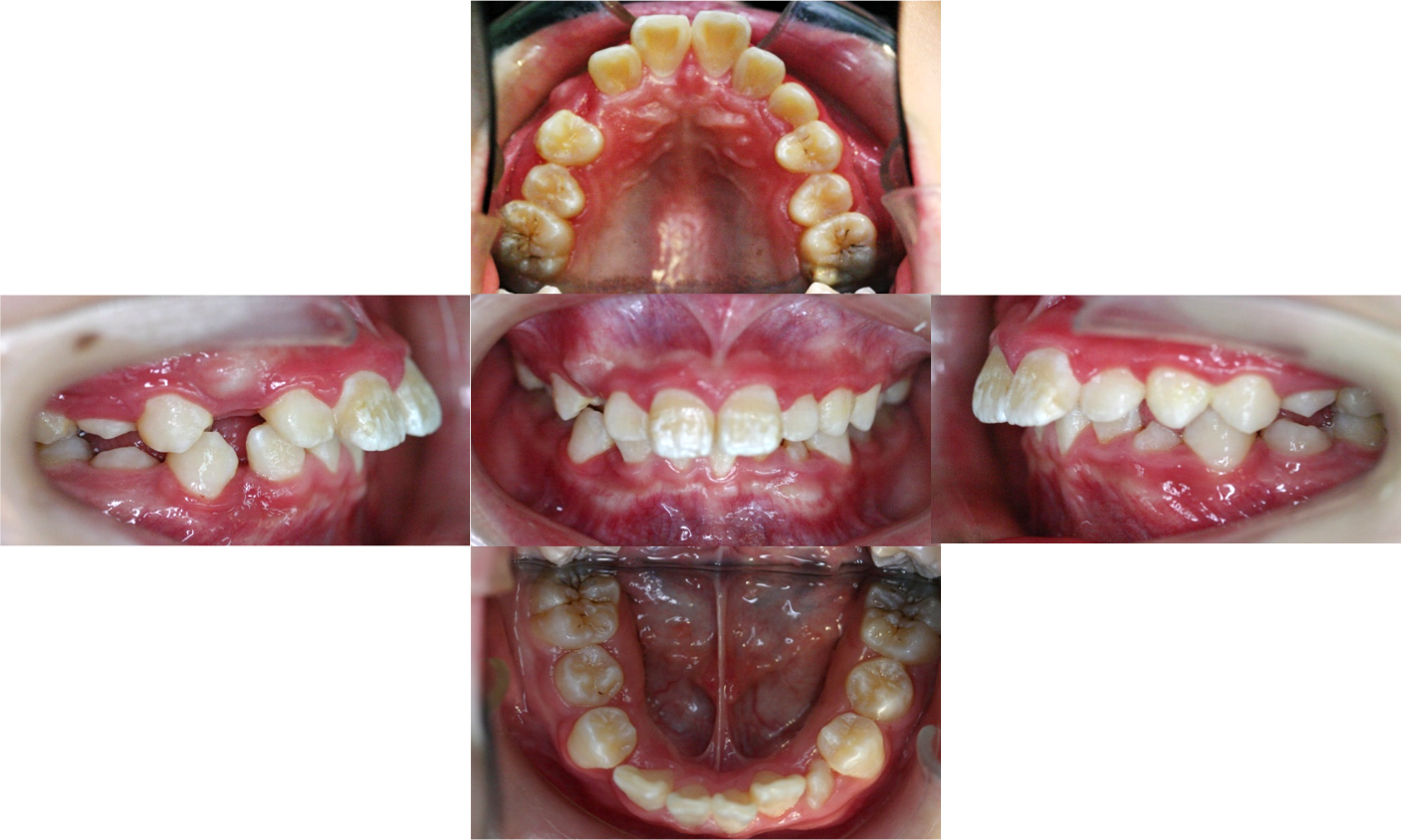 图3示 硬腭高拱,上牙弓狭窄,牙齿排列不齐,上牙前突