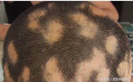 斑秃的学名叫做斑秃,是一种突然发生的局限性斑片状脱发,可发生在身体
