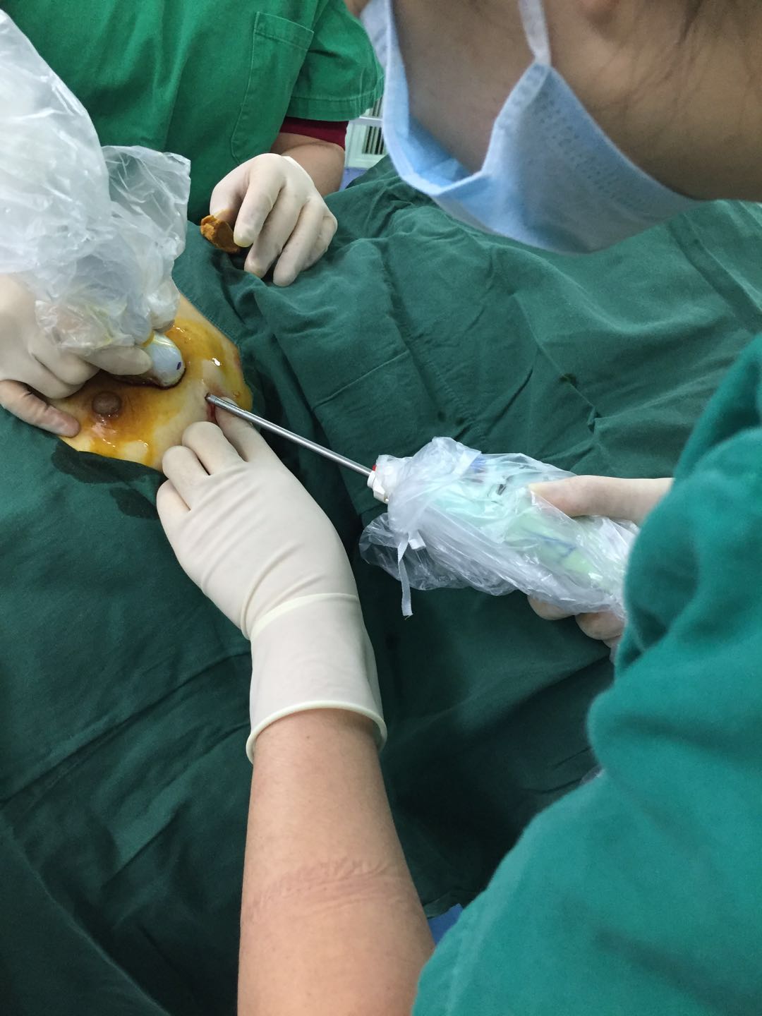 肿块切除后行残腔超声复查手术区域,若无异