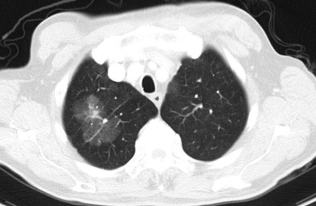 非典型磨玻璃结节(ggo)的表现