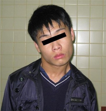 儿童先天性肌性斜颈