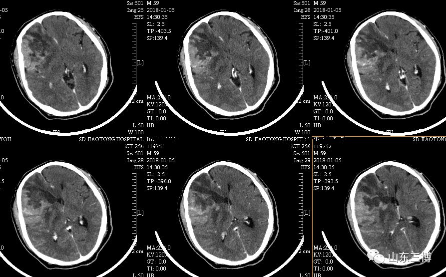山东省立第三医院治疗颅内恶性肿瘤