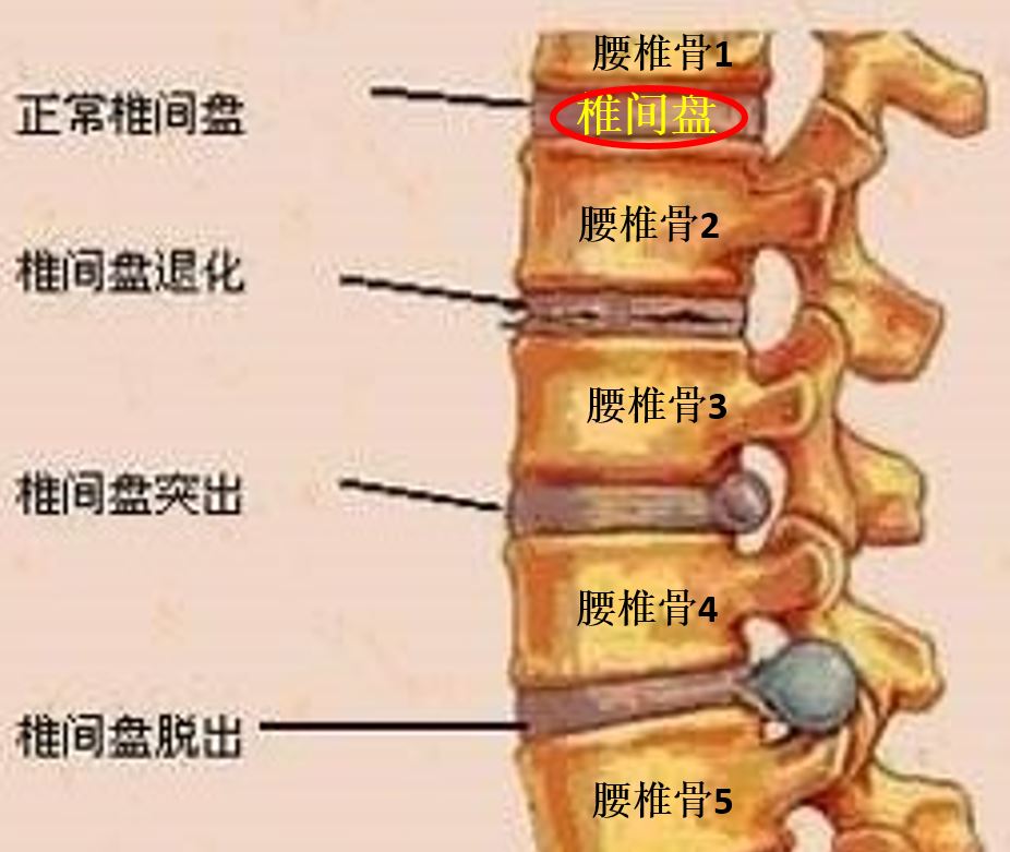 史上最实用腰椎间盘突出经皮穿刺内镜微创手术问答