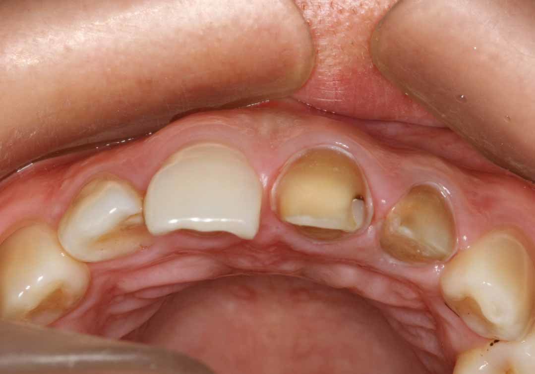 前牙死髓牙变色,行全瓷冠修复