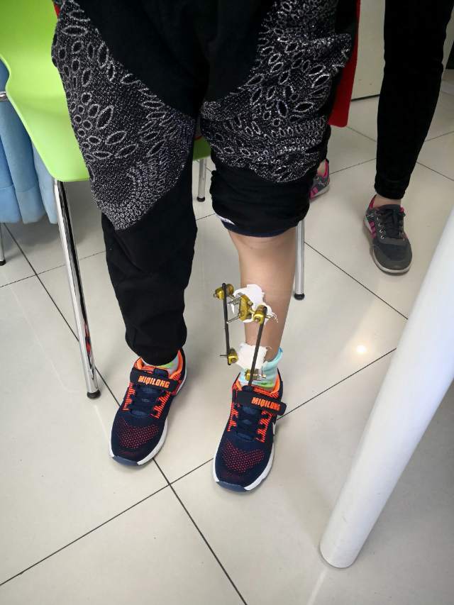 儿童微创治疗之外固定支架技术