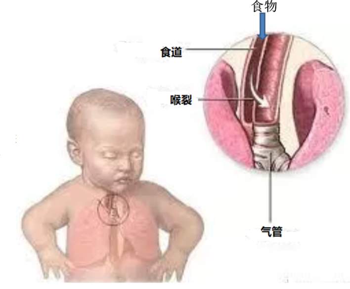 喉劈裂图片