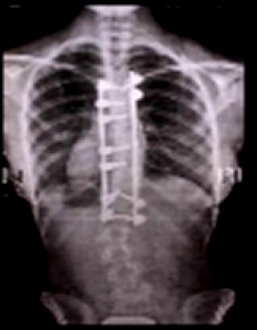 上肢肩背部僵硬麻木疼痛萎缩是什么病--神经根