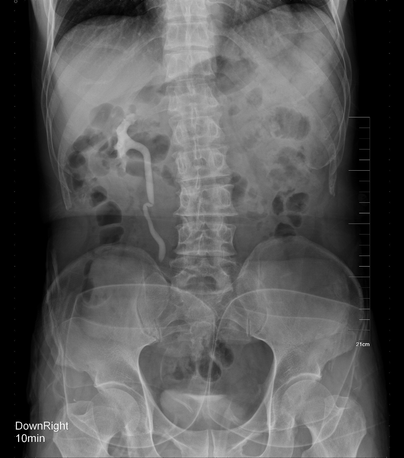 静脉尿路图 竖立位置 输尿管内没有填充缺陷 库存照片. 图片 包括有 小肠, 权利, 气体, 膨胀, 花苞 - 177161588