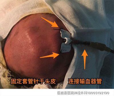 婴儿头皮血肿钙化图片图片