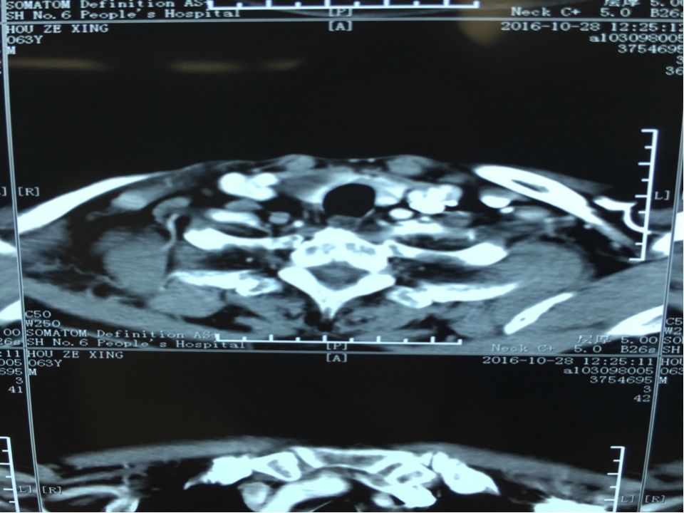 无功能性甲状旁腺囊肿图片