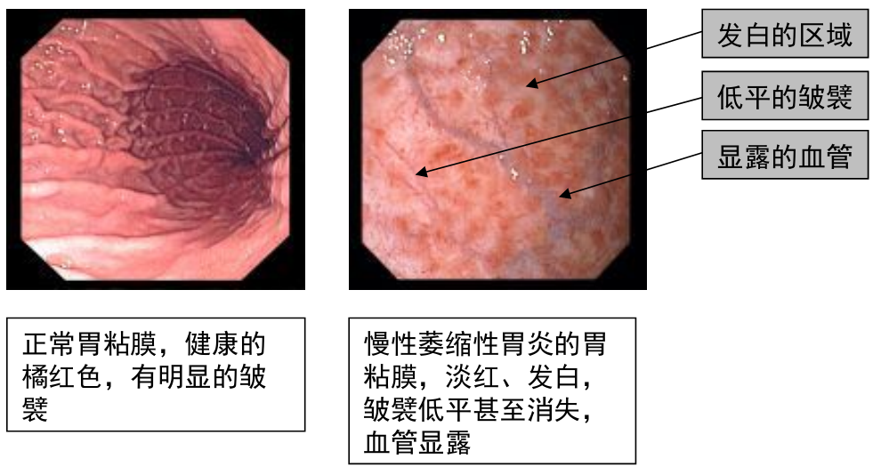 萎缩性胃炎→肠上皮化生→异型增生→胃癌衰老是大自然不可抗拒的规律