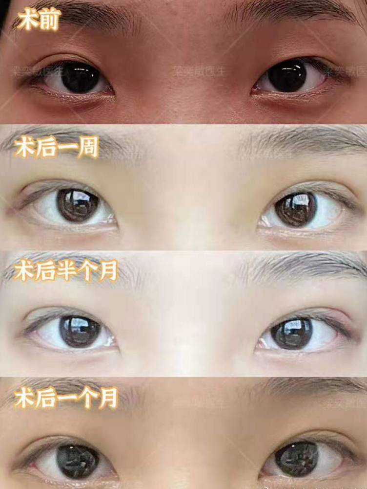 埋线双眼皮案例