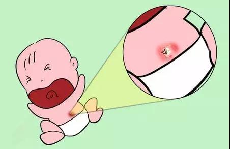 新生宝宝肚脐发炎了,是怎么回事啊