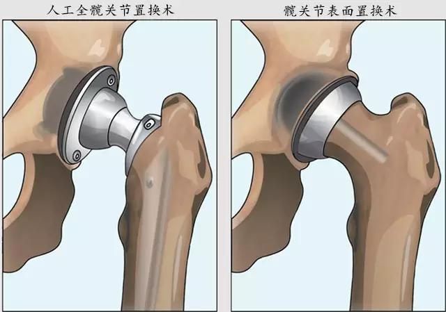 人工全髋关节置换术