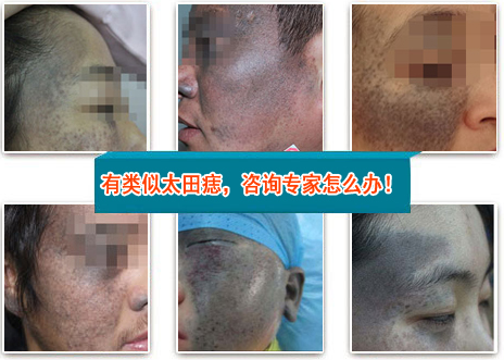 胎记解密:原来这才是青胎记的"真面目"!