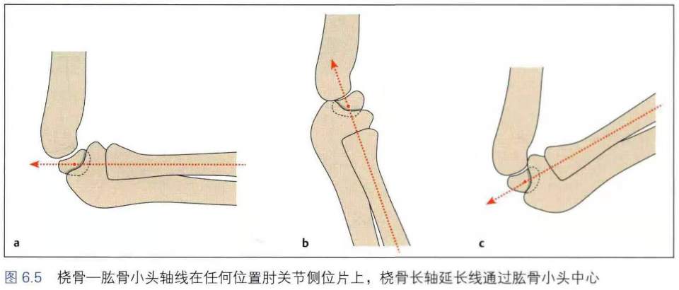 儿童创伤系列警惕漏诊儿童孟氏骨折monteggia