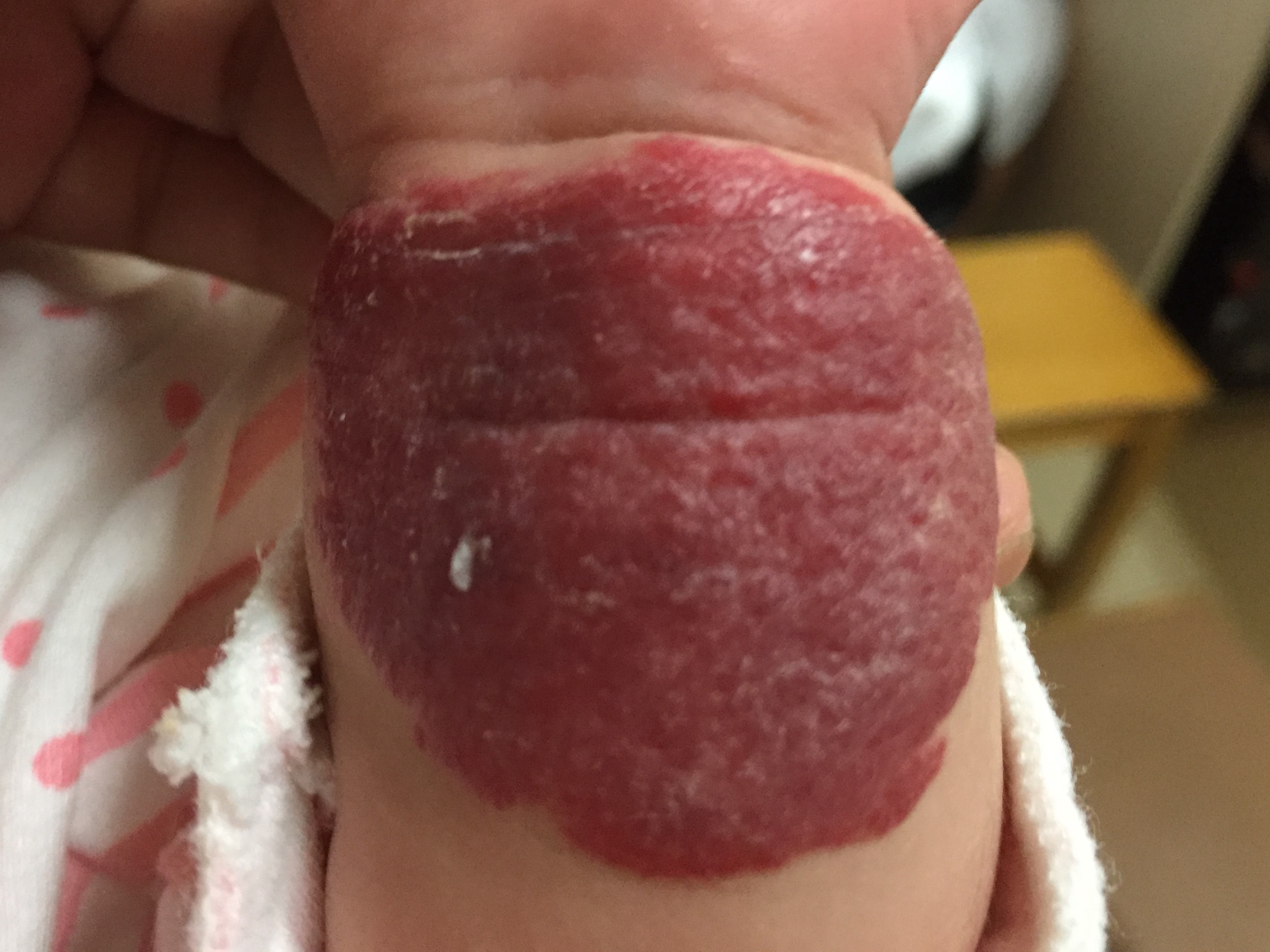 婴儿红斑与血管瘤区别图片