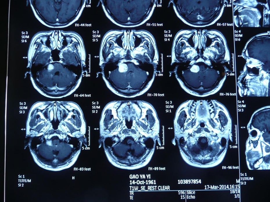 【多例】关于听神经瘤手术切除中的面,听神经保护