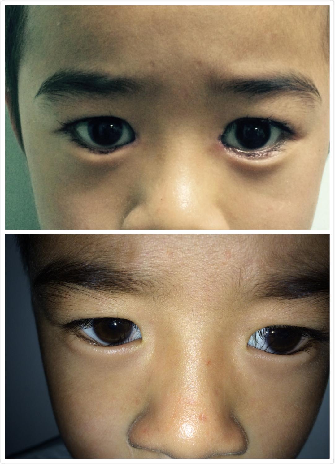 睫毛生长在眼睛上下睑缘上,生长方向有一定倾斜度,上脸睫毛向前上方