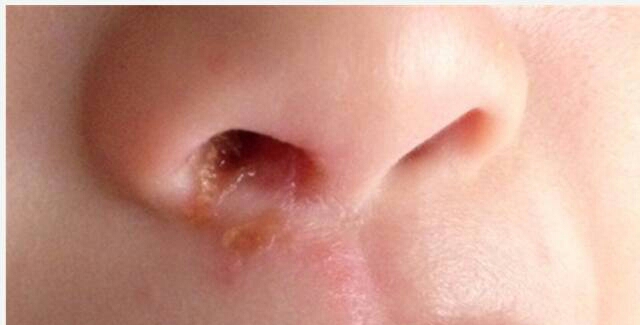 急性期,鼻孔内微痛,局部皮肤红肿,触痛,重者皮肤糜烂,表面盖有薄痂皮