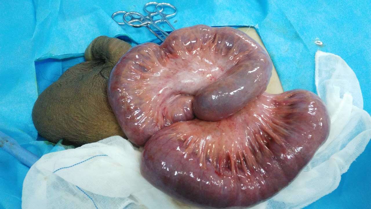巨大阴囊疝气图片