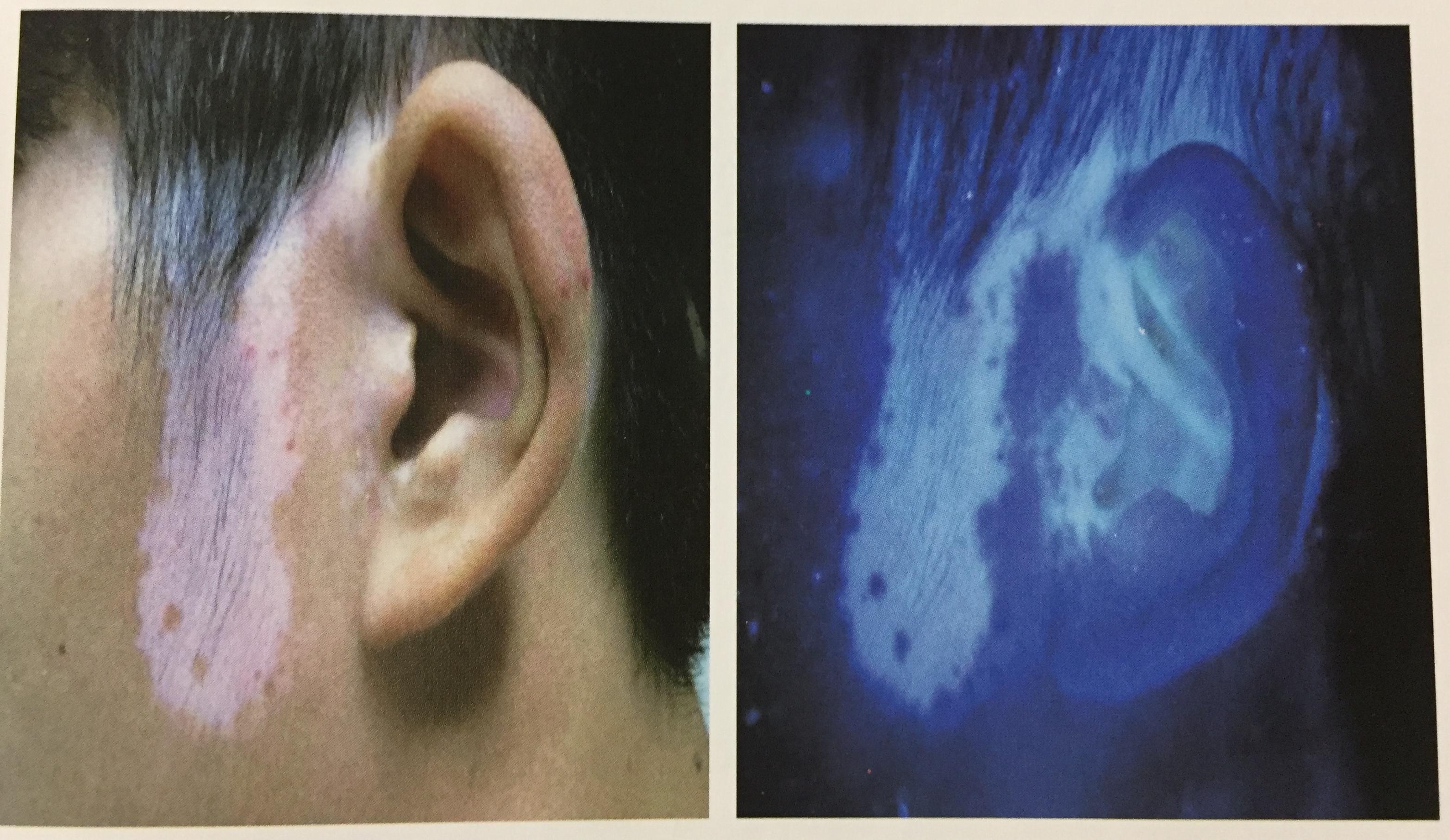 161丨白癜风的照妖镜伍德灯