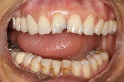 治疗后我们珍惜每一颗牙齿,对待每一位患者,我们都精益求精,不论再