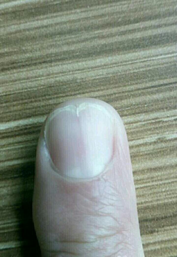 指甲竖纹或分叉气血失畅之信号