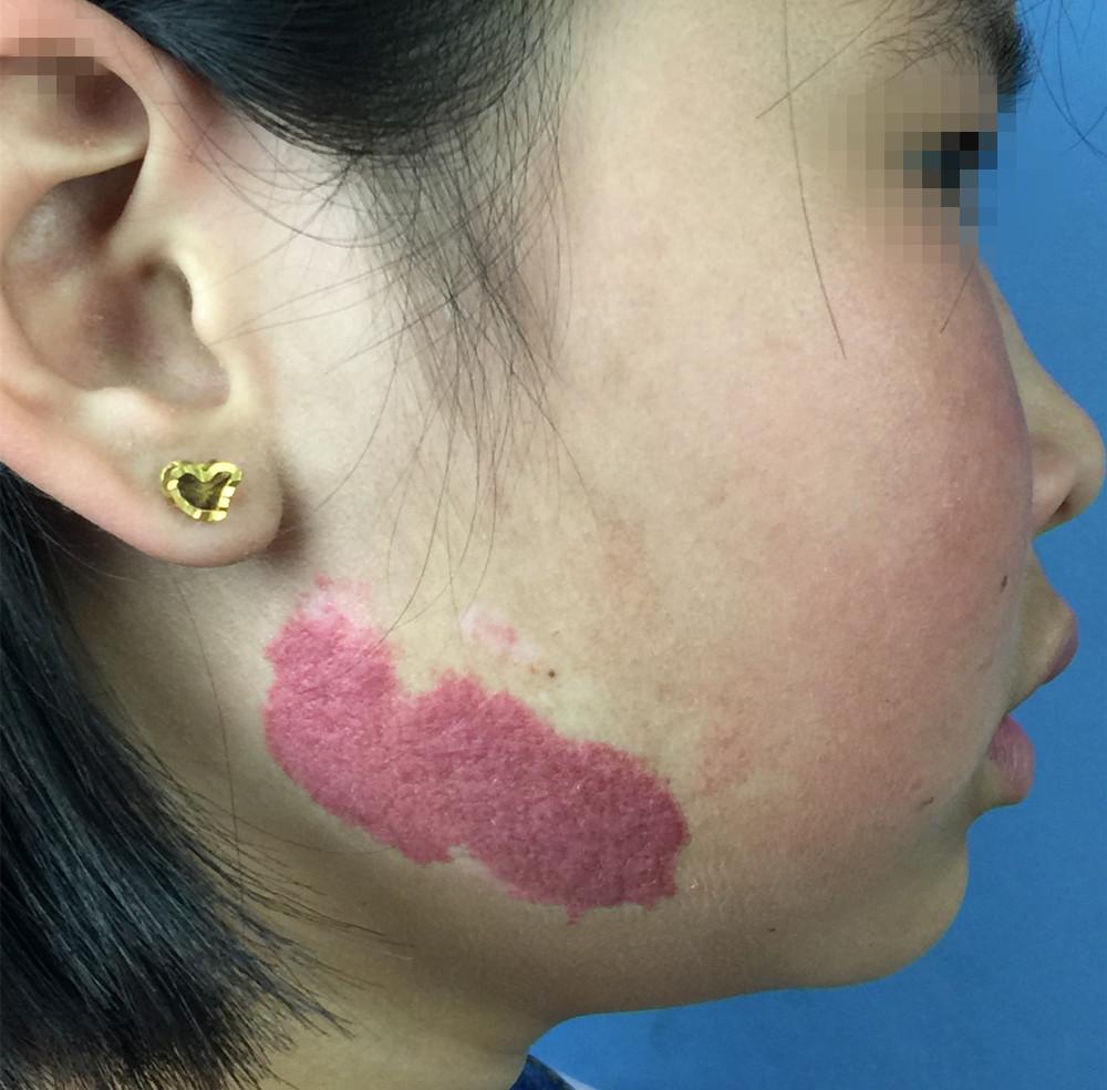 不可小视的胎记——鲜红斑痣 - 微医(挂号网)