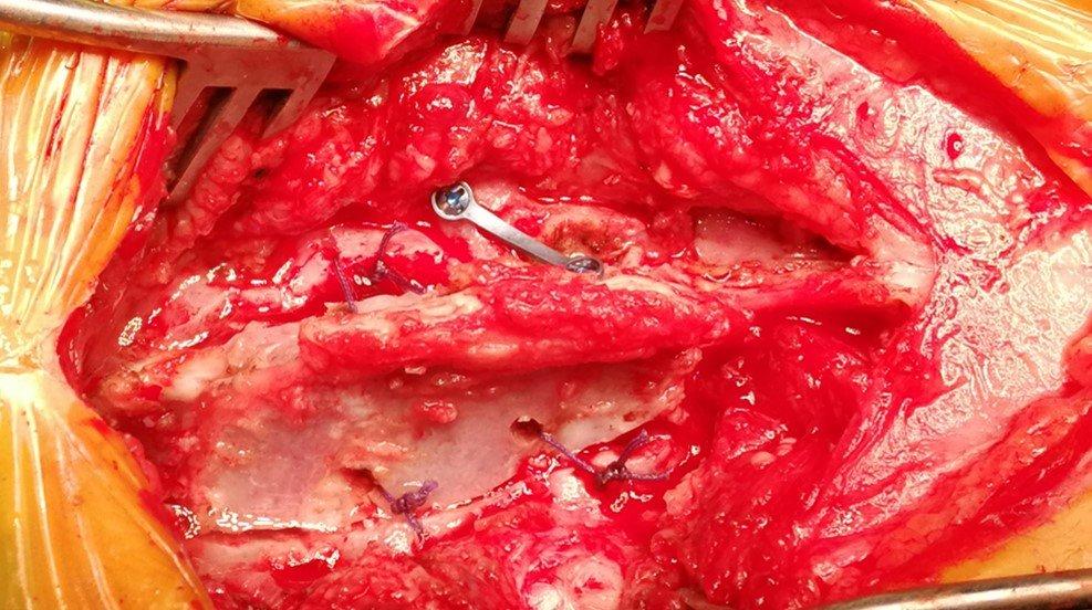 背部血管痣?当心隐形脊柱裂哦!