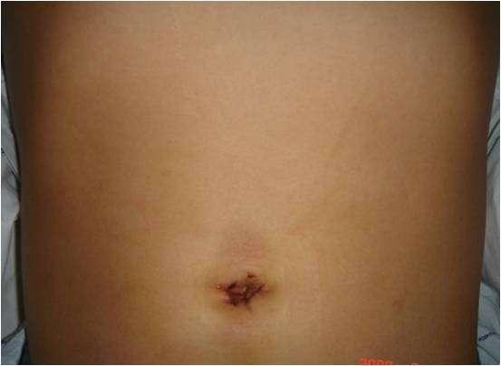 这项技术已被用于进行疝修补,肥胖症手术,甚至切除脾脏,结肠等.