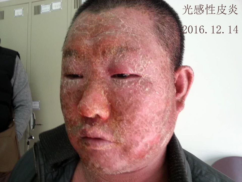 光感性皮炎两例