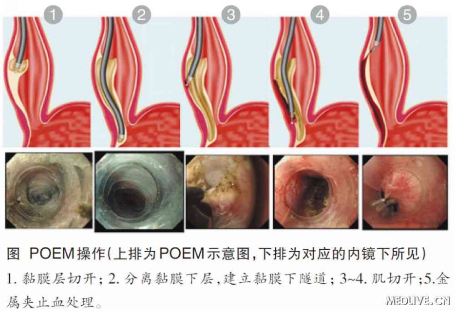 食道炎怎么治疗彻底根除（食道炎症状和治疗方法）