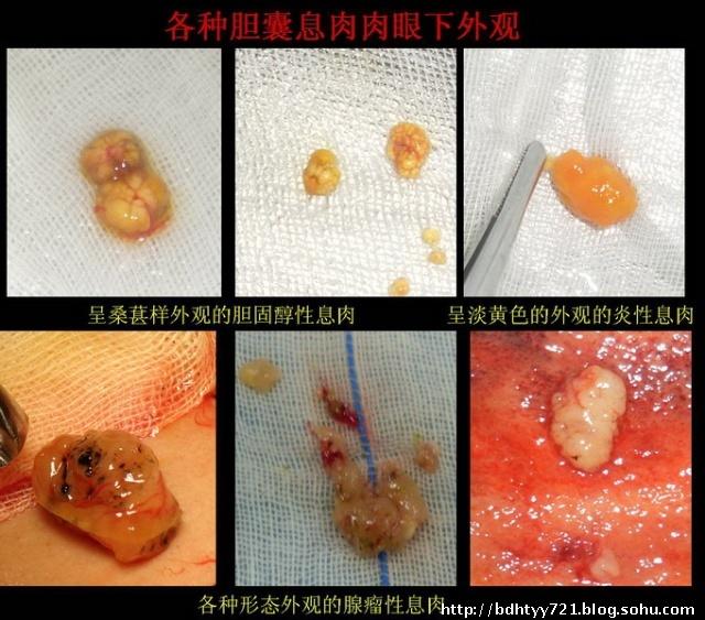 微创保胆囊息肉摘除活检术及各种胆囊息肉外观!