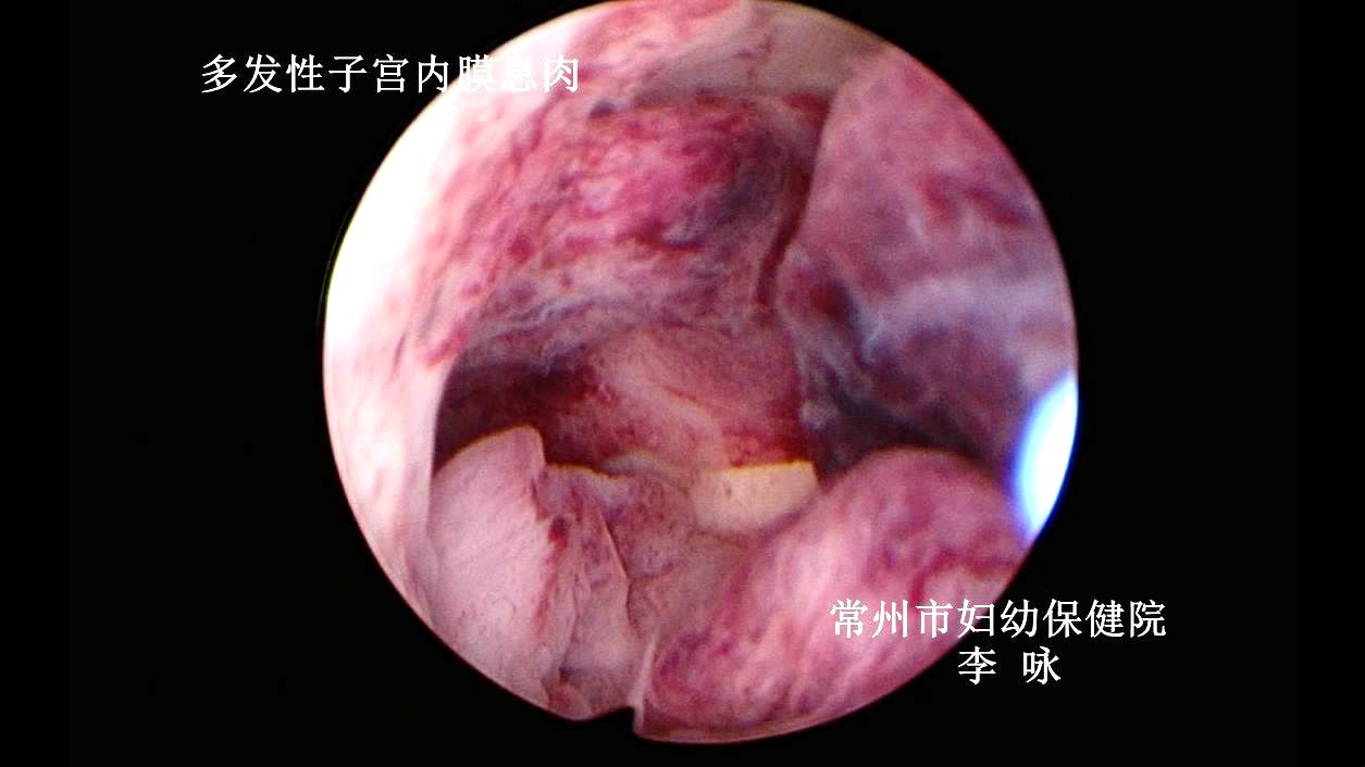 出血不止又想保住子宫当然有办法