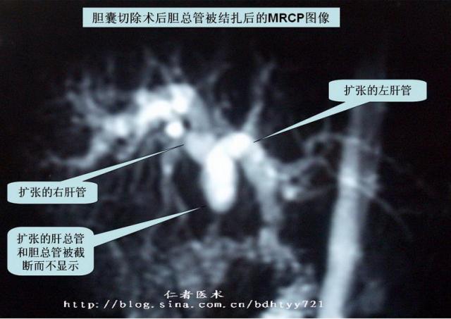 眾所周知,在膽囊切除的手術過程中,由於calots三角的解剖複雜性,加之