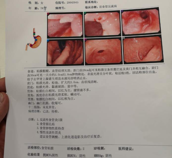 食管裂孔疝内镜图片分享 - 微医(挂号网)