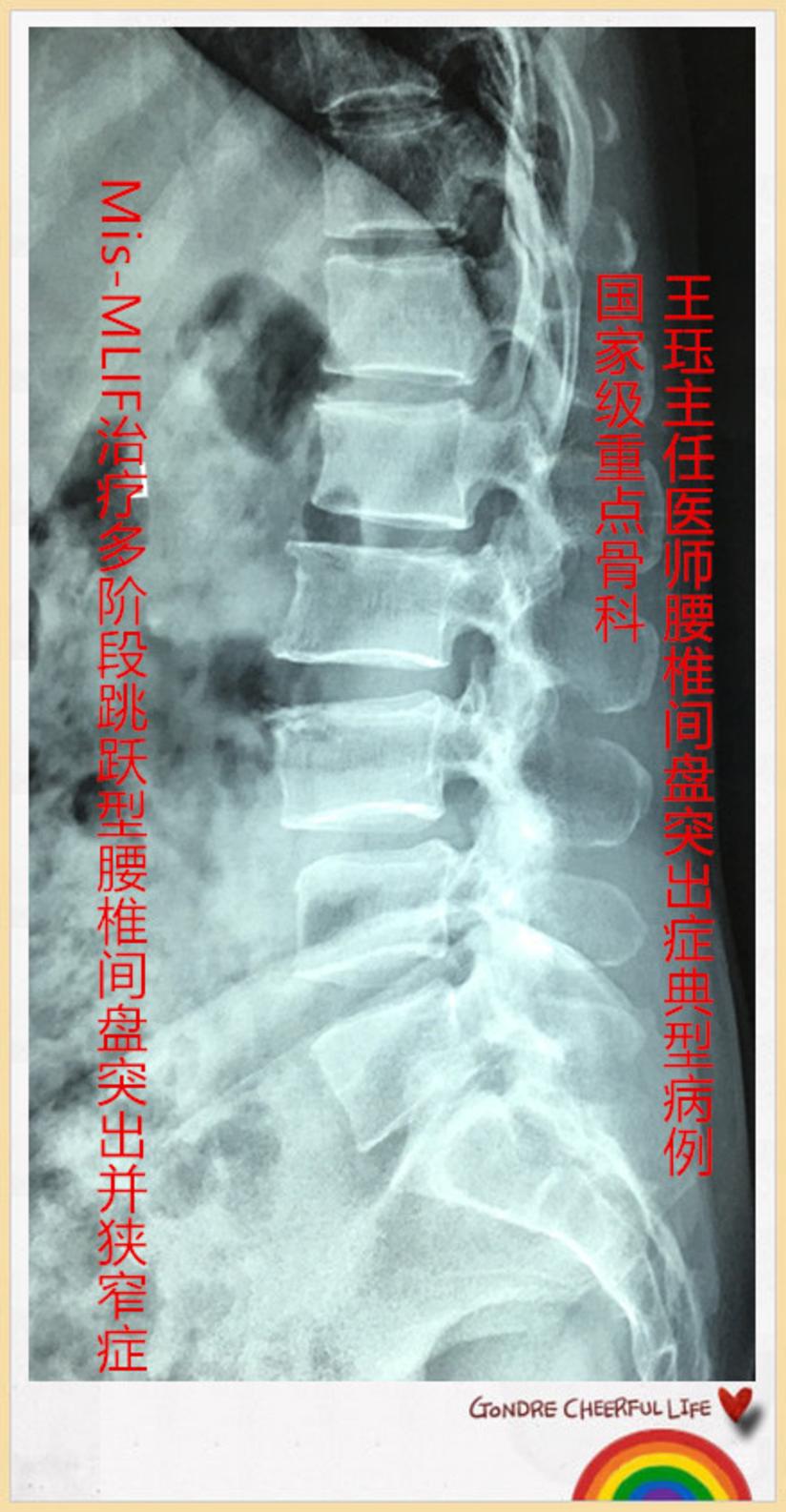 Mis Mlif治疗多阶段跳跃型腰突并狭窄症 健康号 微医